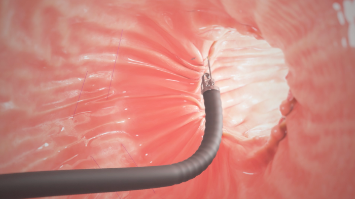 Sutures Tightening to reduce Stomach Size
