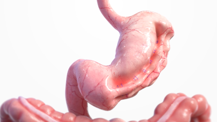 Final ESG Stomach Shape after Suturing