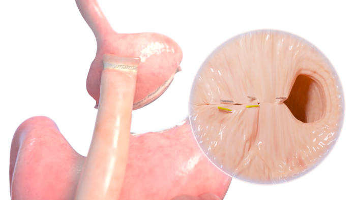 Transoral outlet reduction TORe Illustration